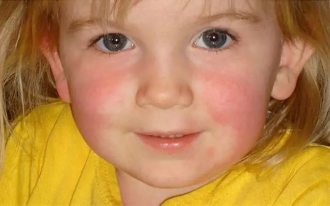 Червоні щоки після холоду: що варто знати про холодовий панікуліт